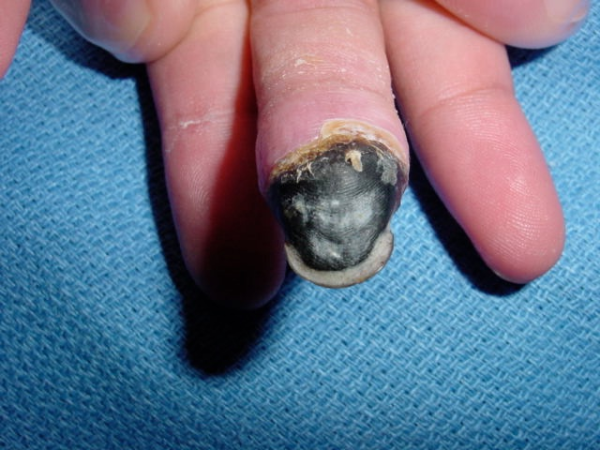 Buerger's Disease