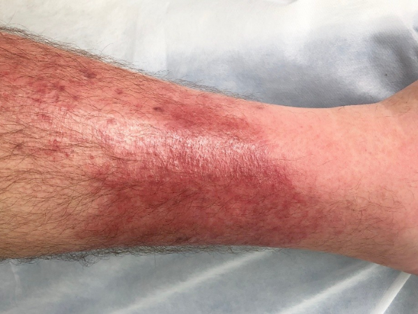 Cellulitis