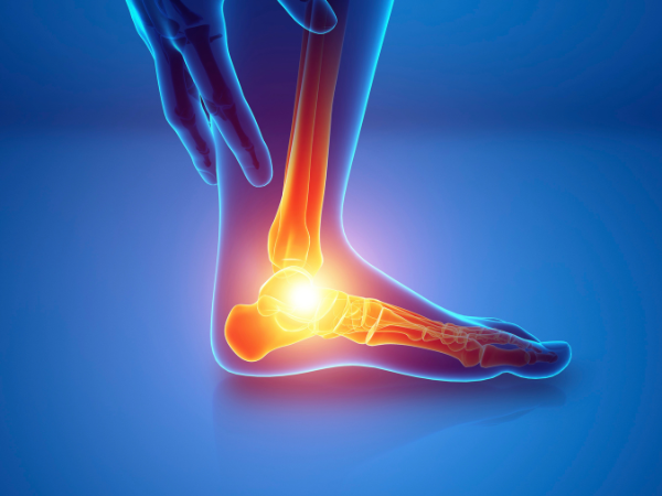 Charcot Foot