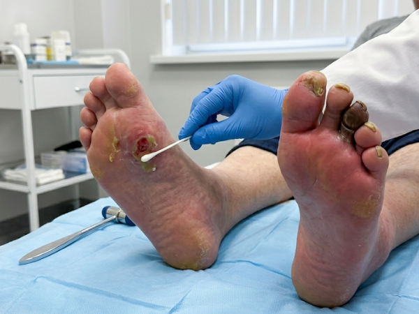 Diabetic Foot Infection