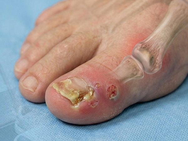 Fungal Nail Infection