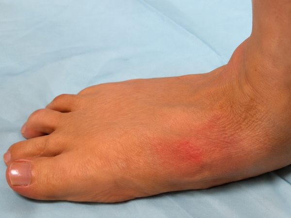 Midfoot Collapse
