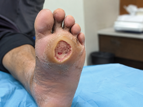 Neuropathic Ulcer