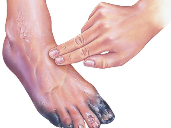 Peripheral Artery Disease (PAD)