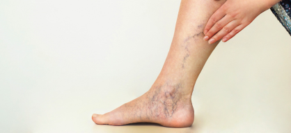 Venous Ulcer